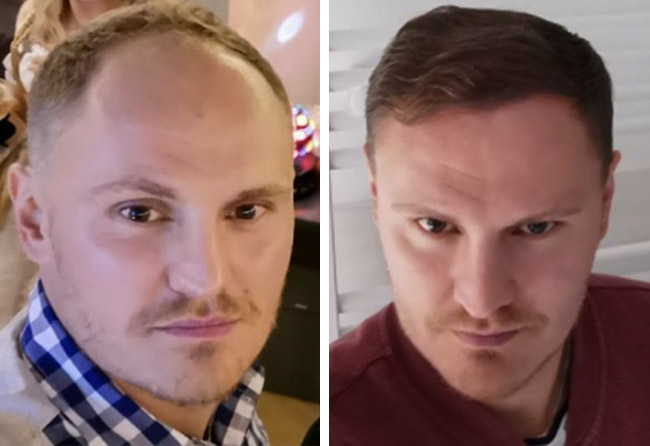 Vorher Nachher DHI Haartransplantation mit 3500 Grafts von Patient Tim Hoffmann