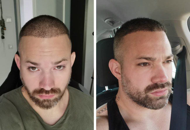 Vorher Nachher DHI Haartransplantation mit 3700 Grafts von Patient Manuel Anderhuber nach 4 Monaten