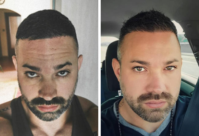 Vorher Nachher DHI Haartransplantation mit 3700 Grafts von Patient Manuel Anderhuber nach 6 Monaten
