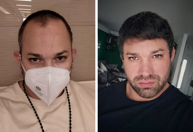 Vorher Nachher DHI Haartransplantation mit 3700 Grafts von Patient Manuel Anderhuber