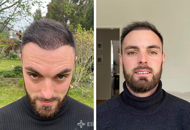 Vorher Nachher DHI Haartransplantation mit 3700 Grafts von Patient Sebastian Kellermann nach 4 Monaten