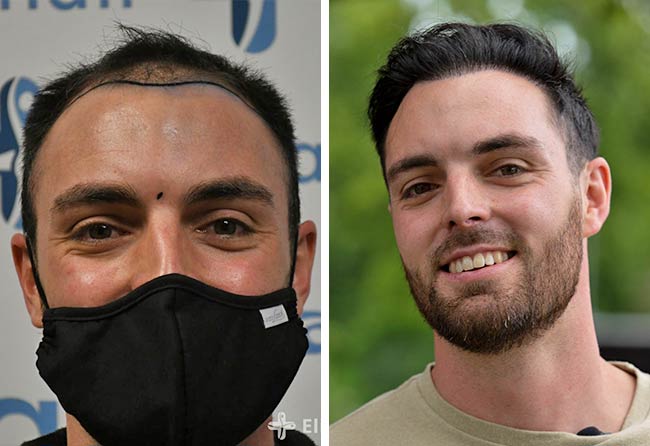 Vorher Nachher DHI Haartransplantation mit 3700 Grafts von Patient Sebastian Kellermann