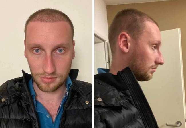 Vorher Nachher DHI Haartransplantation mit 3950 Grafts von Patient Oliver Dietrich nach 2 Monaten