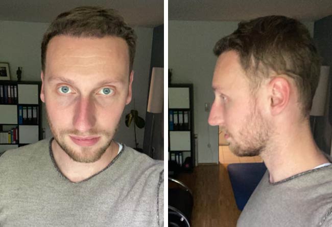 Vorher Nachher DHI Haartransplantation mit 3950 Grafts von Patient Oliver Dietrich nach 4 Monaten