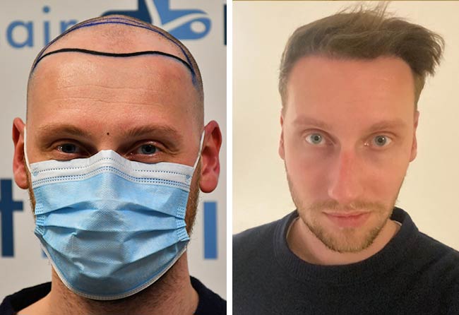 Vorher Nachher DHI Haartransplantation mit 3950 Grafts von Patient Oliver Dietrich