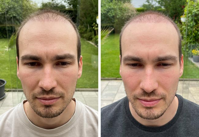 Vorher nachher DHI Haartransplantation mit 4700 Grafts bei Patient Marcel Ploch nach 2 Monaten