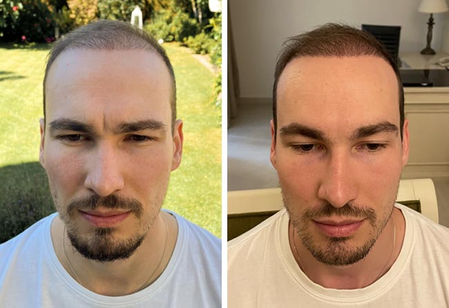 Vorher nachher DHI Haartransplantation mit 4700 Grafts bei Patient Marcel Ploch nach 4 Monaten