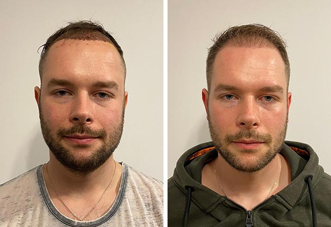 Vorher nachher DHI Haartransplantation mit 4700 Grafts bei Patient Michael Simma nach 3 Monaten