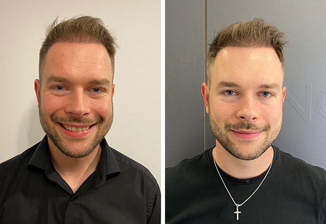 Vorher nachher DHI Haartransplantation mit 4700 Grafts bei Patient Michael Simma nach 5 Monaten