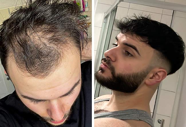 Vorher Nachher DHI Haartransplantation mit 4700 Grafts von Patient Okan Yueksel