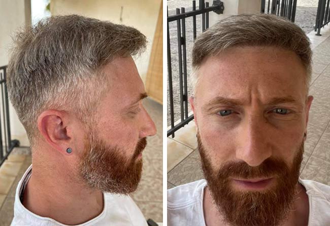 Vorher Nachher DHI Haartransplantation mit 4750 Grafts von Patient Raffaele Leucci nach 7 Monaten