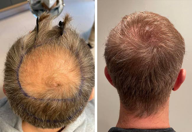 Vorher Nachher DHI Haartransplantation mit 4750 Grafts von Patient Raffaele Leucci