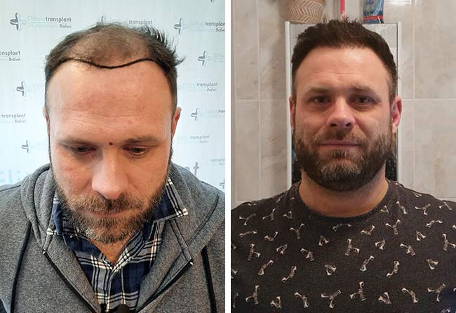 Vorher Nachher Perkutan Haartransplantation mit 3700 Grafts von Patient Michael Woulfe