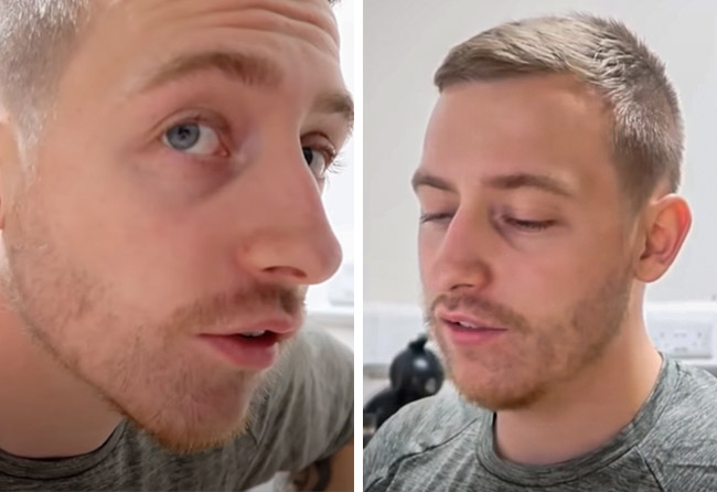 Vorher nachher Saphir Barttransplantation mit 4200 Grafts bei Patient Jay Jones nach 2 Monaten