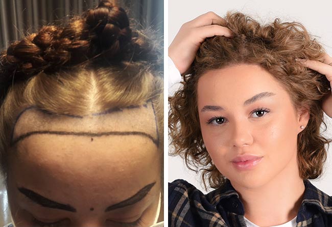 Vorher Nachher Saphir Haartransplantation mit 2600 Grafts von Patientin Lilianna Steinhöffel