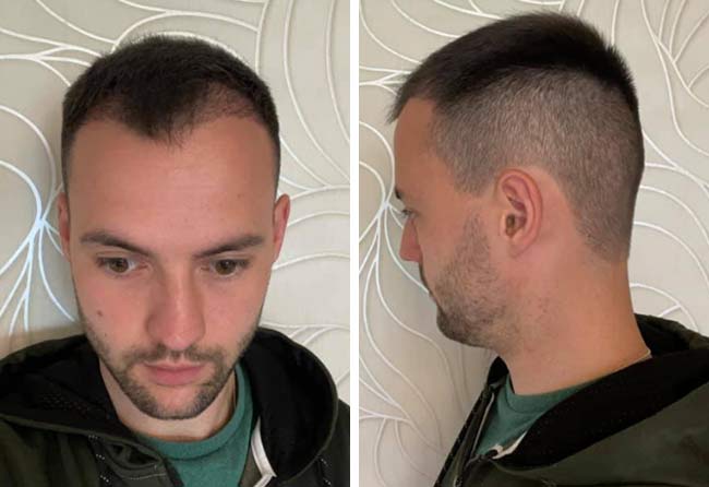 Vorher nachher Saphir Haartransplantation mit 2700 Grafts bei Patient Alexander Volwerk nach 2 Monaten