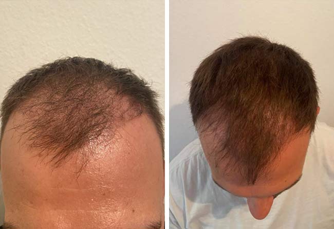 Vorher Nachher Saphir Haartransplantation mit 4500 Grafts von Patient Sefket Ahmetovic nach 3 Monaten