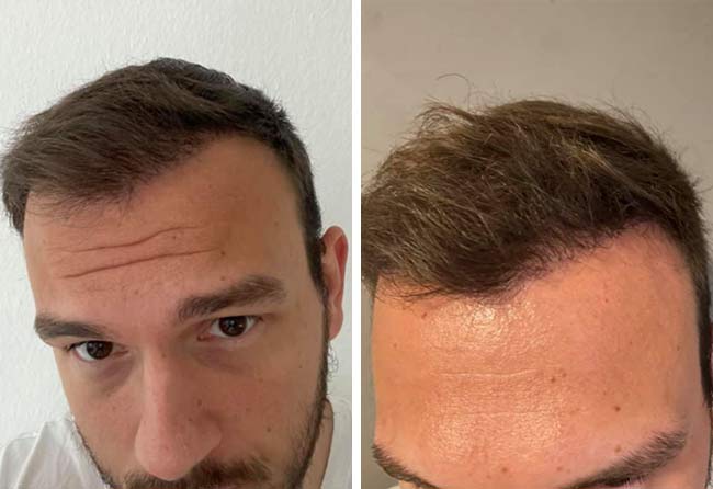 Vorher Nachher Saphir Haartransplantation mit 4500 Grafts von Patient Sefket Ahmetovic nach 6 Monaten
