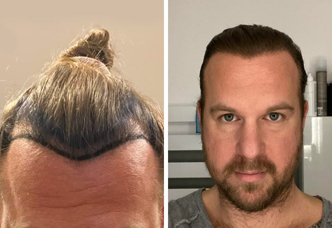 Vorher Nachher SDHI Haartransplantation mit 2700 Grafts von Patient Matthias Funk