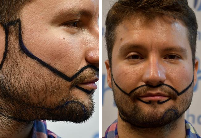 Vorher Saphir Barttransplantation mit 3500 Grafts von Patient Dominik Schmitz