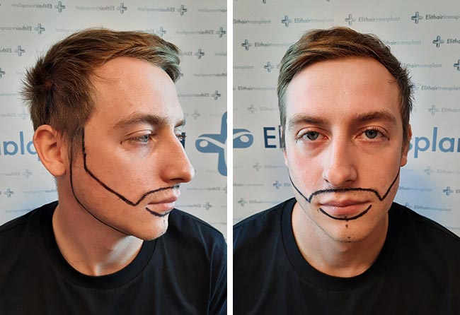 Vorher Saphir Barttransplantation mit 4200 Grafts von Patient Jay Jones