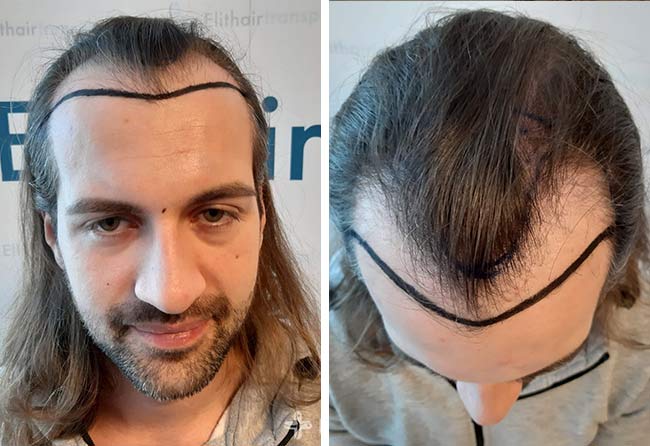 Vorher Saphir Haartransplantation mit 4000 Grafts bei Patient Cagatay Türkseven