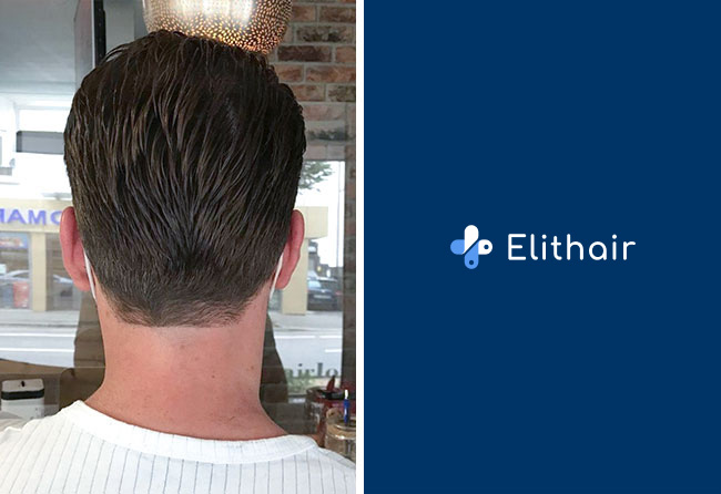 Haartransplantation Vorher Nachher Spenderbereich Ergebnis nach 5 Monten von Patient Cagatay