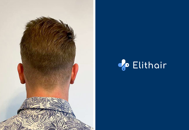 Haartransplantation Vorher Nachher Spenderbereich nach 2 Monaten von Patient Michael