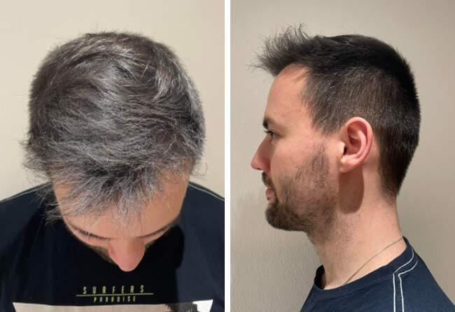 Vorher nachher Saphir Haartransplantation mit 2700 Grafts bei Patient Thorsten S. nach 5 Monaten