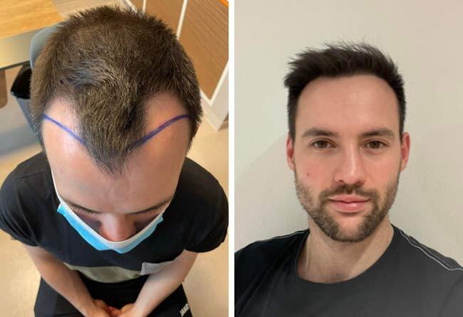 Vorher Nachher Saphir Haartransplantation mit 2700 Grafts von Patient Thorsten S.