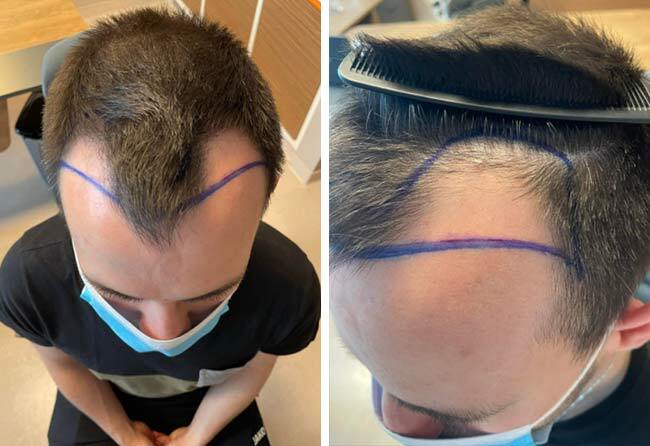 Vorher Saphir Haartransplantation mit 2700 Grafts bei Patient Thorsten S.