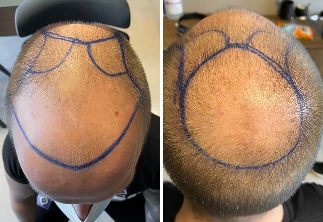 Vorher DHI Haartransplantation mit 5200 Grafts von Patient Dominik König