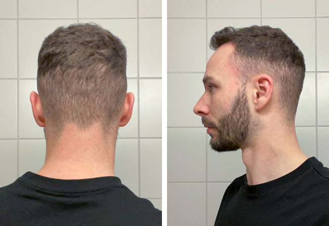 Nachher DHI Haartransplantation mit 4700 Grafts von Patient Kriss Kross