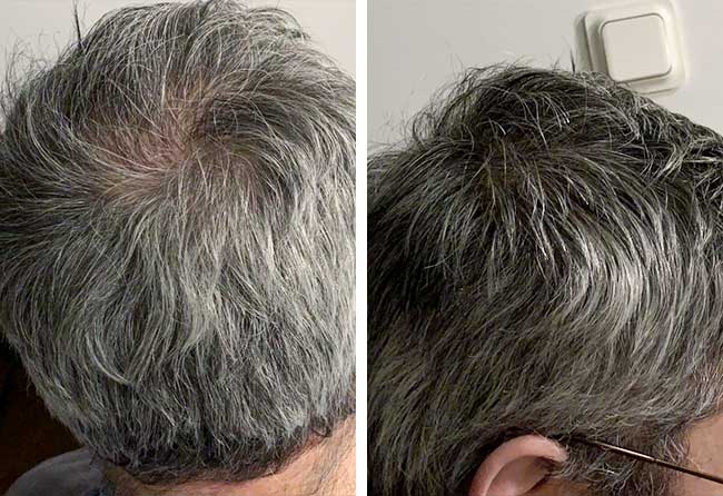 Nachher Saphir Haartransplantation mit 3000 Grafts von Patient Ziad Ma