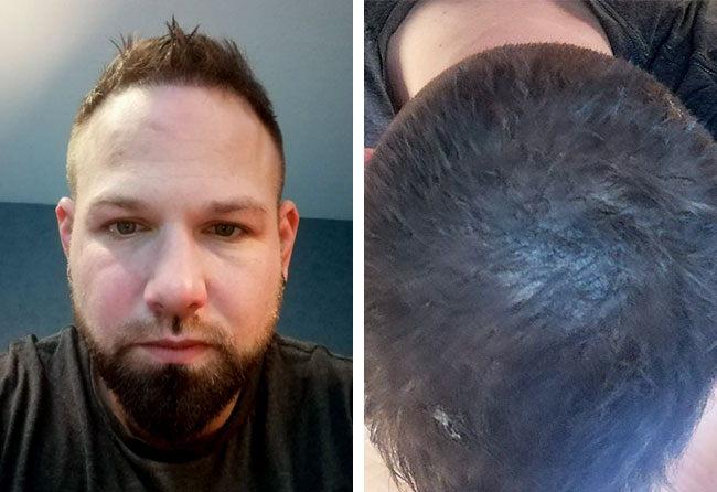 Nachher Saphir Haartransplantation mit 4700 Grafts von Patient Patrick Bertram