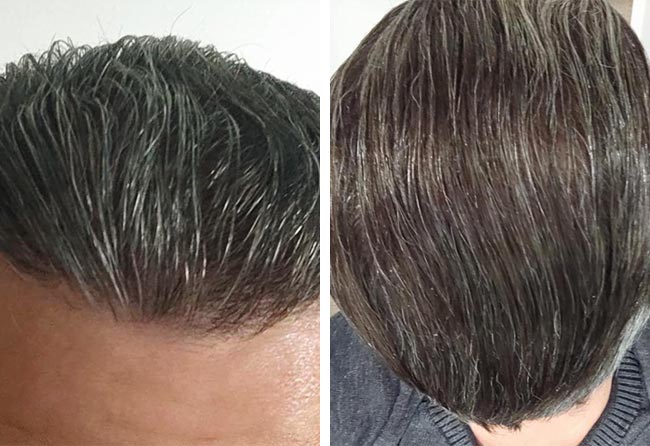 Nachher Saphir Haartransplantation mit 3100 Grafts von Patient Dani el