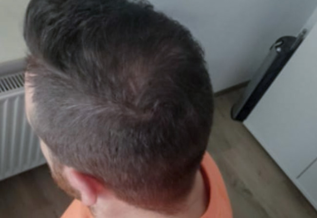 Nachher Saphir Haartransplantation mit 4000 Grafts von Patient Tho Marky