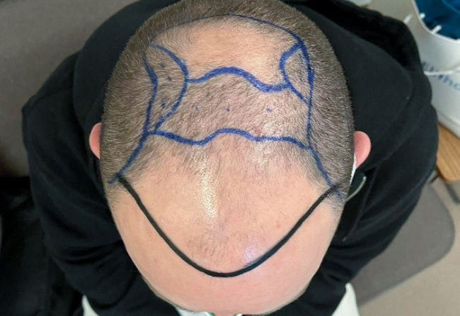 Vorher DHI Haartransplantation mit 4700 Grafts von Patient Kriss Kross