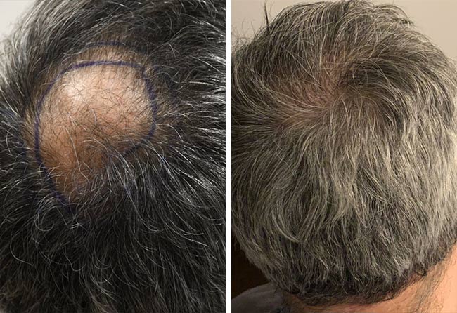 Vorher Nachher Saphir Haartransplantation mit 3000 Grafts von Patient Ziad Ma