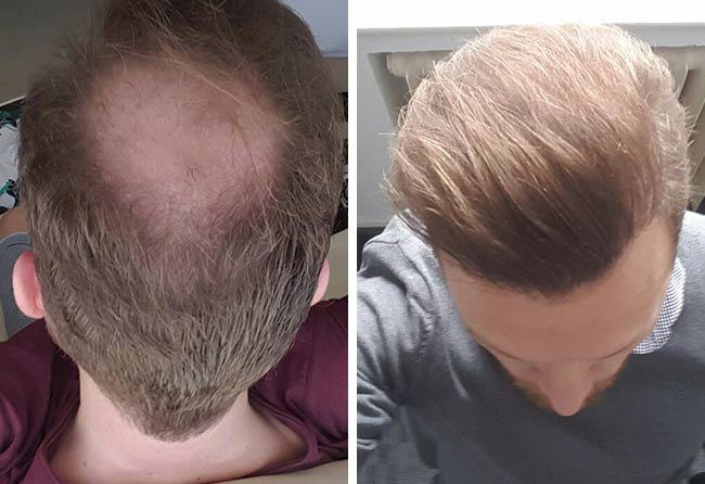 Vorher Nachher Saphir Haartransplantation mit 3700 Grafts von Patient Stefan Heckman