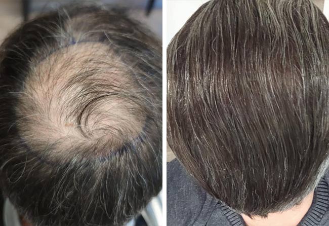 Vorher Nachher Saphir Haartransplantation mit 3100 Grafts von Patient Daniel el
