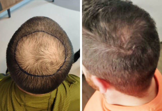 Vorher Nachher Saphir Haartransplantation mit 4000 Grafts von Patient Tho Marky