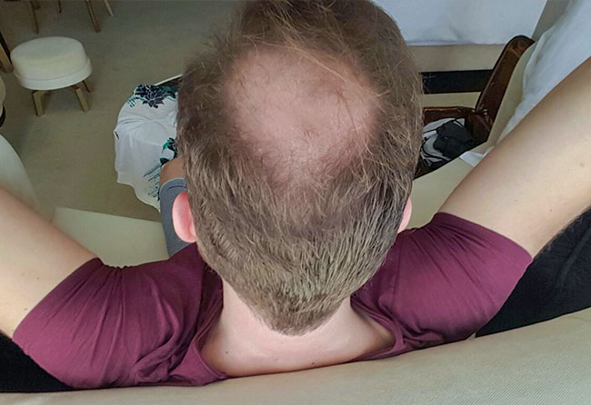 Vorher Saphir Haartransplantation mit 3700 Grafts von Patient Stefan Heckman