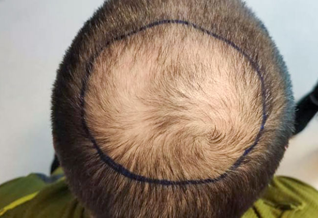Vorher Saphir Haartransplantation mit 4000 Grafts von Patient Tho Marky