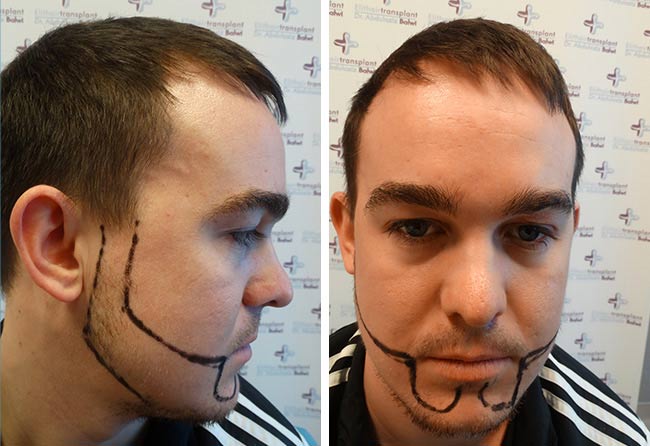 Vorher Saphir Barttransplantation mit 4300 Grafts bei Patient Oliver N