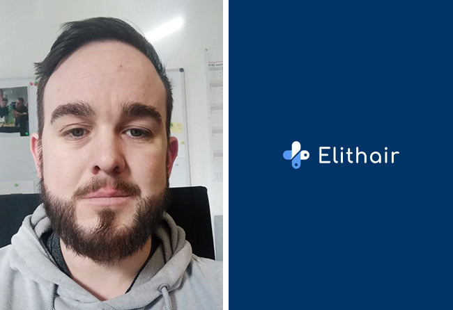 Nachher Saphir Barttransplantation mit 4300 Grafts bei Patient Oliver