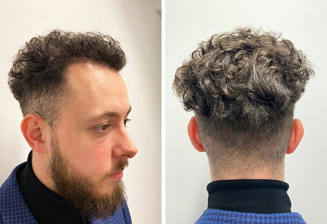Cilian W nach 18 Wochen DHI Haartransplantation mit 3140 Grafts