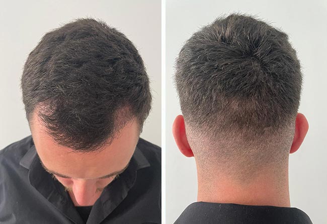 Cilian W nach 2 Monaten DHI Haartransplantation mit 3140 Grafts