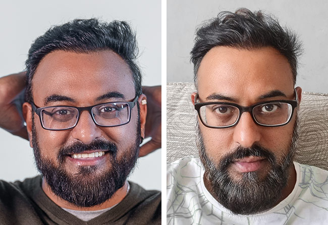 Ergebnis der DHI Haartransplantation mit 4000 Grafts von Patient Shahid A.