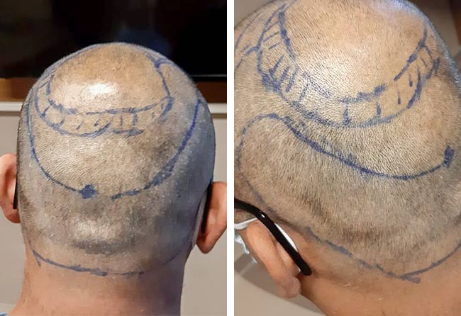 Patient Shahid Ahmad vor der OP mit der DHI Haartransplantation mit 4000 Grafts
